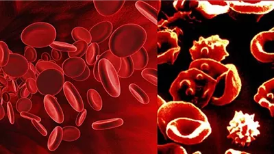 اليوم العالمي لـ الثلاسيميا 2024.. الصحة توفر أول مركز للمصابين.. تطبيق أحدث طرق العلاج.. وهذه أهم أعراض المرض