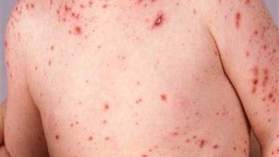 انتشار وفاة الأطفال في المغرب، المملكة تكشف الأسباب الكاملة 