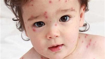 صحة الجيزة: الجدري المائي يهدد الأطفال في نهاية الشتاء وبداية الربيع