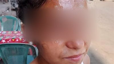 التفاصيل الكاملة لواقعة تشويه وجه طالبة على يد معلمة بالجيزة
