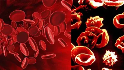 في اليوم العالمي لمرض الثلاسيميا 2024، هيئة الدواء تكشف أهم أعراضه