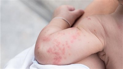 أعراض حساسية الصيف عند الأطفال وطرق العلاج والوقاية