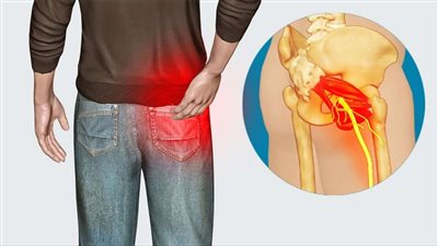 أعراض عرق النسا، وأسباب الإصابة وطرق العلاج