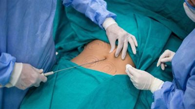 نصائح عليك اتباعها قبل إجراء عملية شفط الدهون