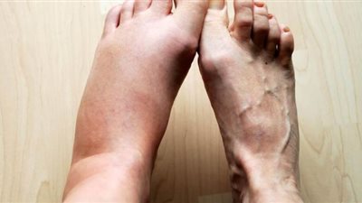 طريقة تشخيص التهاب القدم السكرية