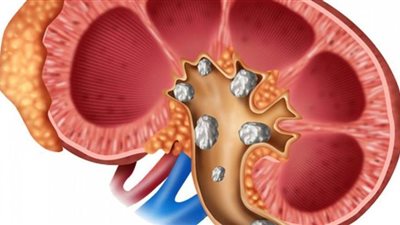 علاج وأعراض حصوات الكلى