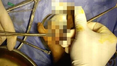 إجراء جراحة متقدمة لمريض أصيب بقطع يده في حادث بالشرقية | صور