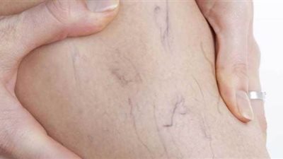 علاج الغرغرينا| أستاذ جراحات أوعية دموية يكشف أحدث طرق علاج الغرغرينا