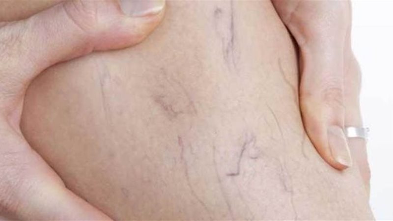 علاج الغرغرينا