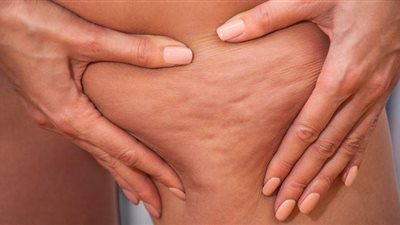 اصنعي بنفسك كريم لعلاج السيلوليت في المنزل