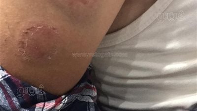 أسرة طفل بالمنوفية تتهم زوجة والده بضربه بسبب قطعة فراخ |صور