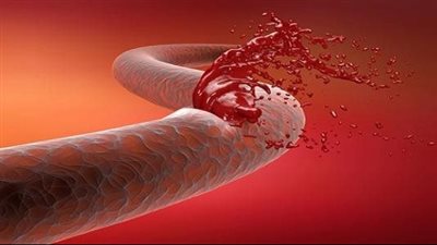 أسباب وأنواع وأعراض النزيف الداخلي وطرق التعامل معه