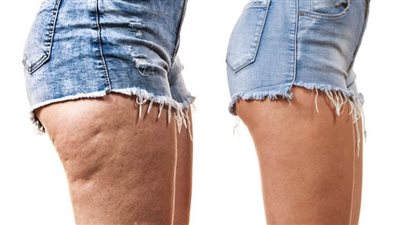 ٣ خلطات سحرية تخلصك من السيلوليت