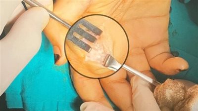 الصحة تكشف تفاصيل الجراحات النادرة في مستشفي شبرا العام 