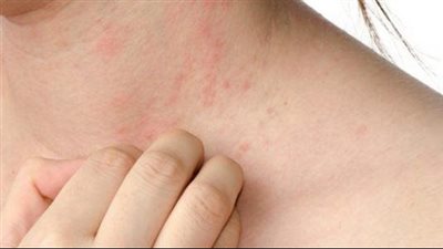 ٤ نصائح للحماية من جفاف الجلد