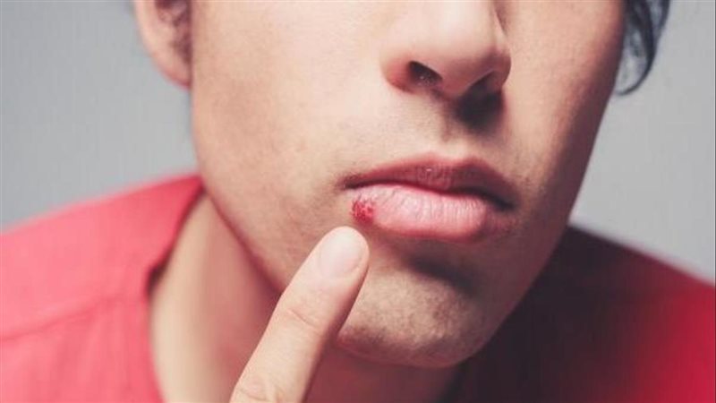 أعراض الهربس