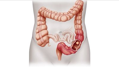 أعراض القولون العصبي عند النساء