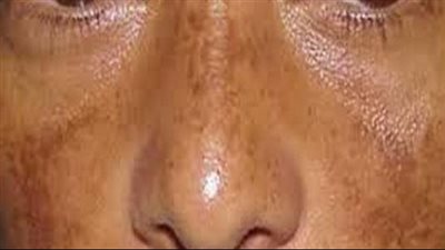 كريم البطاطس للتخلص من البقع الداكنة بالبشرة في الصيف