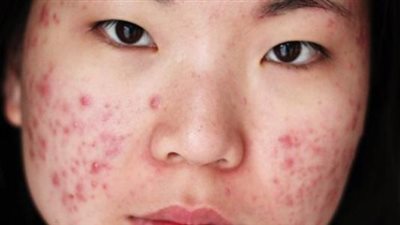 وصفة سحرية تزيل آثار الحبوب من البشرة سريعا 