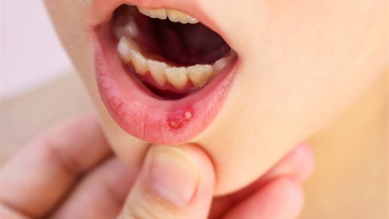 أعراض مرض الهربس،فيتو