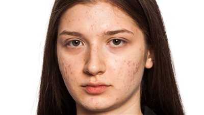 قناع فيتامين e يخلصك من حب الشباب ويعيد نضارة البشرة 