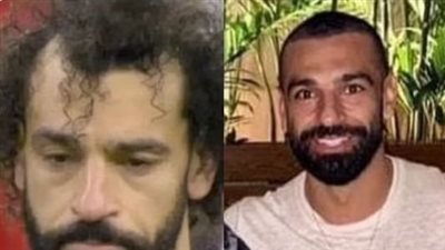 بعد إجراء محمد صلاح عملية لزراعة الشعر، طبيب يكشف أنواع عملية زراعة الشعر وأعراضها الجانبية