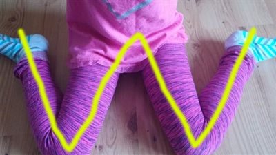 مخاطر جلوس طفلك على شكل حرف W