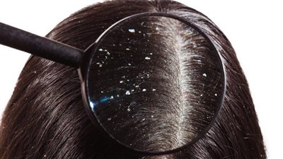 وصفات طبيعية لعلاج قشرة الرأس، أبرزها الزبادي وزيت شجرة الشاي