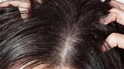 وصفة سحرية للتخلص من الدهون المتراكمة بفروة الرأس 