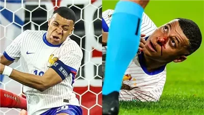 إصابة دموية لـ مبابي في افتتاح مشوار فرنسا باليورو (صور)