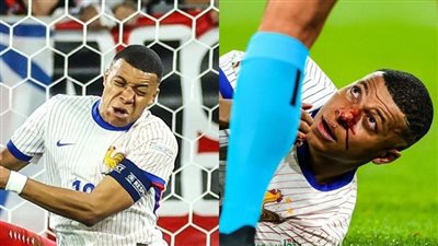 أول تعليق من مبابي بعد إصابته في مباراة النمسا ورد فعل الجماهير 