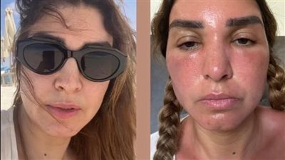 قدر الله وما شاء فعل، أول تعليق من روجينا على إصابتها بحروق في وجهها بسبب الشمس 