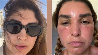 بعد تعرض الفنانة روجينا لحروق الشمس، اعرفي أسبابها وطرق الوقاية منها