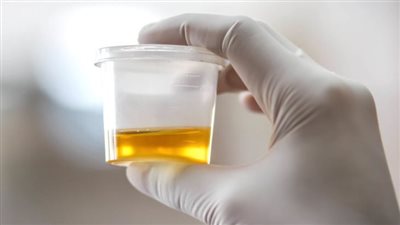 أعراض وجود أملاح بالبول، وطرق علاجه المختلفة