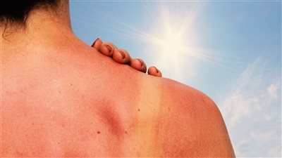 أسباب وطرق علاج حروق الشمس المختلفة
