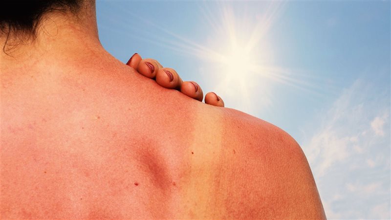 علاج حروق الشمس،