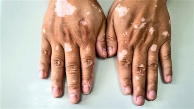اليوم العالمي للبهاق 2024.. المرض آمن وغير معد.. التنمر أهم الصعوبات أمام المصابين.. وهذه أهم أعراضه وطرق علاجه 