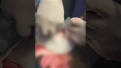 يمني يبتلع 80 قلم حبر وسماعتي أذن