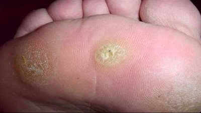 علاج عين السمكة في القدم، وطرق الوقاية منها