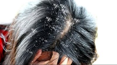 نصائح مهمة تساعد فى علاج قشرة الشعر 