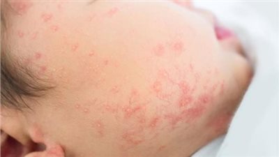 أسباب طفح الحرارة عند الأطفال وطرق التعامل معه 