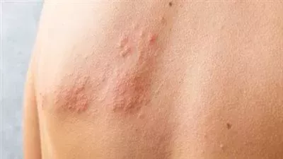 للمصابين بفيروس الهربس، هيئة الدواء تكشف طرق العلاج 