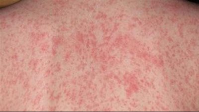 أنواع الطفح الجلدي عند الأطفال والرضع فى فصل الصيف 