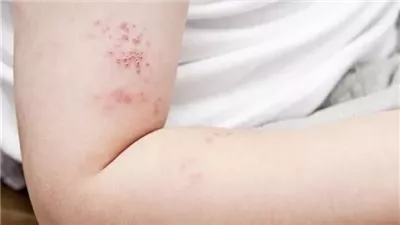 ​هل يمكن أن تنتقل العدوى بالحزام الناري للمحيطين بالمريض؟ هيئة الدواء تجيب 