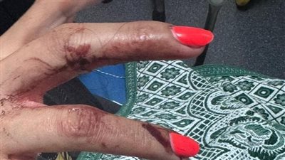 جروح غائرة وقطع وتر، ننشر التقرير الطبي لفتاة التجمع تزامنا مع أولى جلسات محاكمة سائق أوبر 