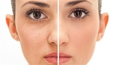 نشا البطاطس حل سحري لتفتيح البقع الداكنة بالبشرة