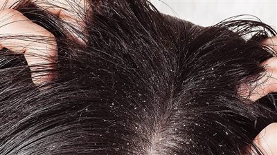 وصفة طبيعية لتنظيف فروة الرأس وعلاج القشرة 