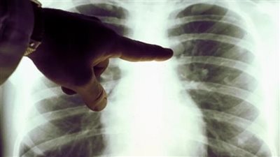 كيف تؤدي الراحة في الفراش للإصابة بالانسداد الرئوي، وما هي طرق علاجه؟