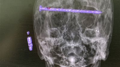 إخراج مسمار طوله 15 سم من رأس رجل في الأورال الروسية