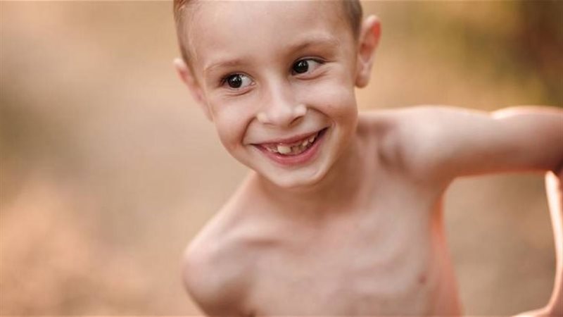 النحافة عند الأطفال